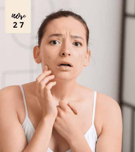 7 WAYS TO GET RID OF ACNE SCARS FAST