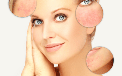 SKINCARE GURU: SKINCARE TIPS AND PRACTICES THAT COULD SAVE YOU WITH YOUR ROSACEA